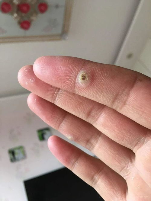 手上长"瘊子"是怎么回事?