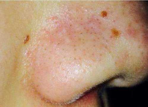 脸上有螨虫的症状图片脸上螨虫痘痘图片