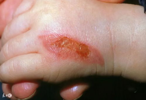 开水烫伤抹牙膏管用吗被油烫伤抹牙膏管用吗