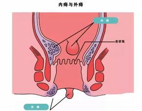 外痔初期图片长什么样图片