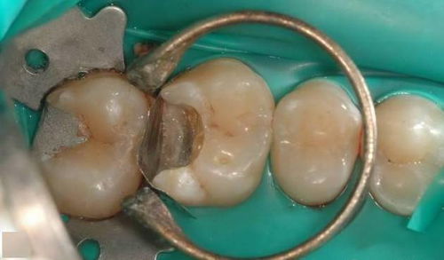 补牙步骤图解补牙流程图