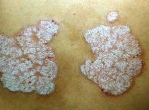 牛皮肤癣用什么洗澡呢