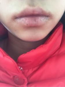 唇炎的诱发因素是什么诱发唇炎的主要原因