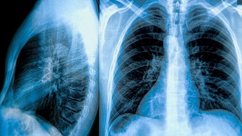 如何治愈肺炎患者