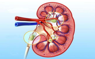 如何排出肾结石