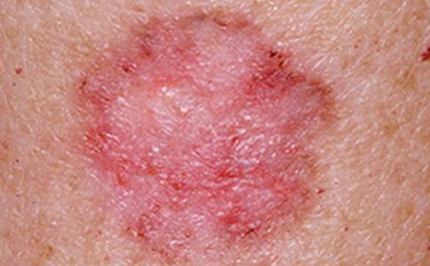 怎么检测皮肤癌皮肤癌怎样检查