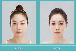 瘦脸针时效是多少