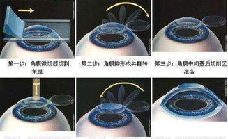 全飞秒手术怎么样