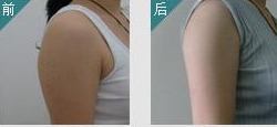 抽脂前后对比照片
