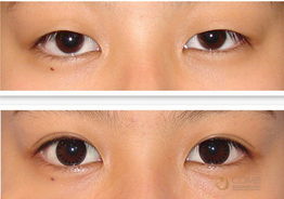 南京哪里割双眼皮好