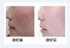 胎记一般几次才能去除