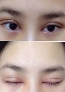 双眼皮快速消肿的方法如下