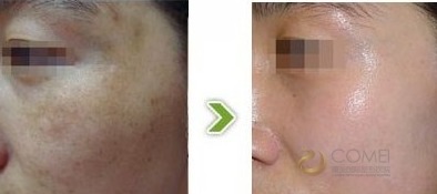 妊娠斑可以去掉吗