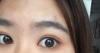 割双眼皮有什么危害或者后遗症