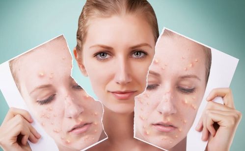 怎样去青春痘最有效的方法