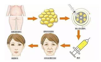 自体脂肪填充面部能保持多长时间