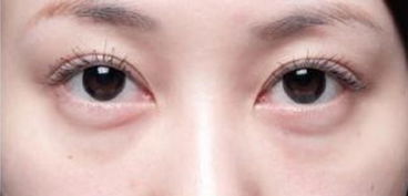 眼袋抽脂多少钱