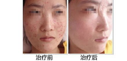 深圳青春痘治疗哪里好