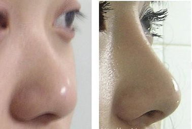 隆鼻假体取出来后能恢复到以前吗