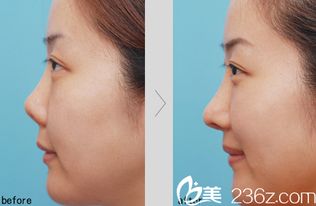 鼻翼缩小加耳软骨垫鼻尖多少钱