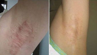 怎么去疤痕最有效的方法