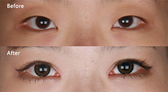 杭州双眼皮哪里好