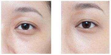 脂肪填充全脸多久恢复自然