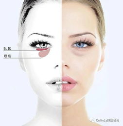 眼袋和卧蚕的区别