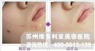 激光去疤痕价格表