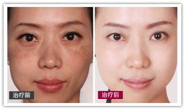 突出的泪痣可以用激光去吗