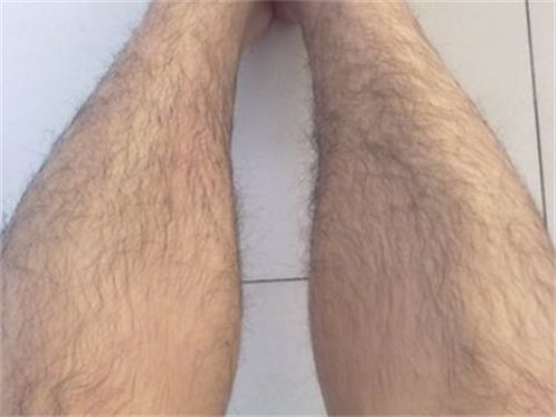 怎样去除腿毛不再长出