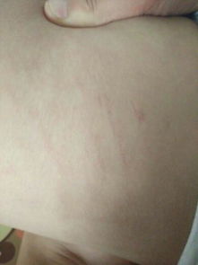 大腿上红血丝怎么消除