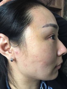 面部线雕失败图片告诉你线雕的副作用