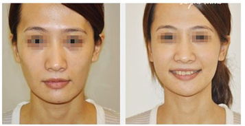 自体填充太阳凹大概能维持多久