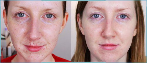 激光祛斑有效果么