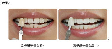 冷光美白多少钱一次