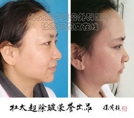 手术除皱有副作用吗