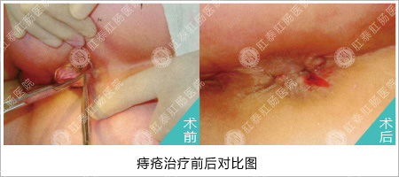 痣疮怎么治最有效果