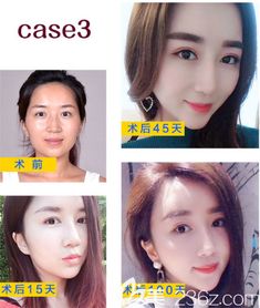 面部填充多久消肿