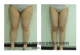 吸脂减肥有效果吗