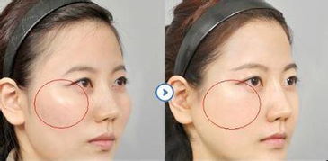 高颧骨怎么改善