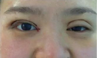 割完双眼皮注意事项有哪些忌口