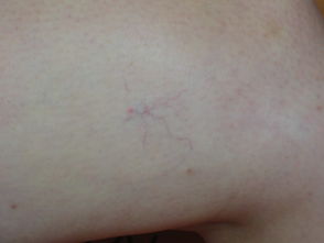 腿部红血丝消除的方法