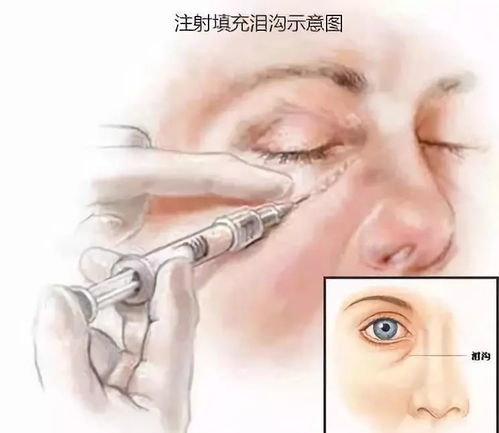 玻尿酸填充泪沟失败图片