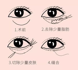 如何消除泪沟的方法