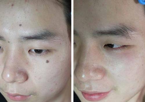 点痣术后注意事项