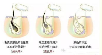 激光部脱毛多少钱