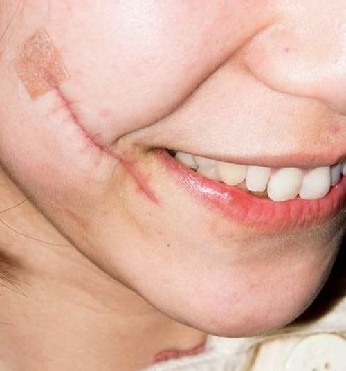 面部疤痕修复价格一览表