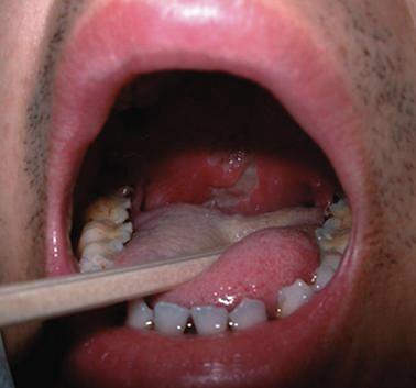 1 白塞病病人多为青壮年,因口腔溃疡的疼痛而焦虑,沮丧和恐惧.