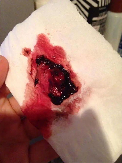 月经量很少,颜色发黑是怎么回事呢